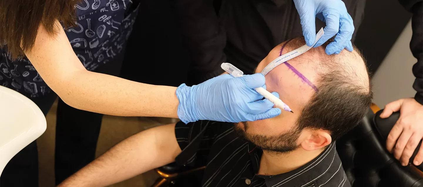Dhi hair transplant