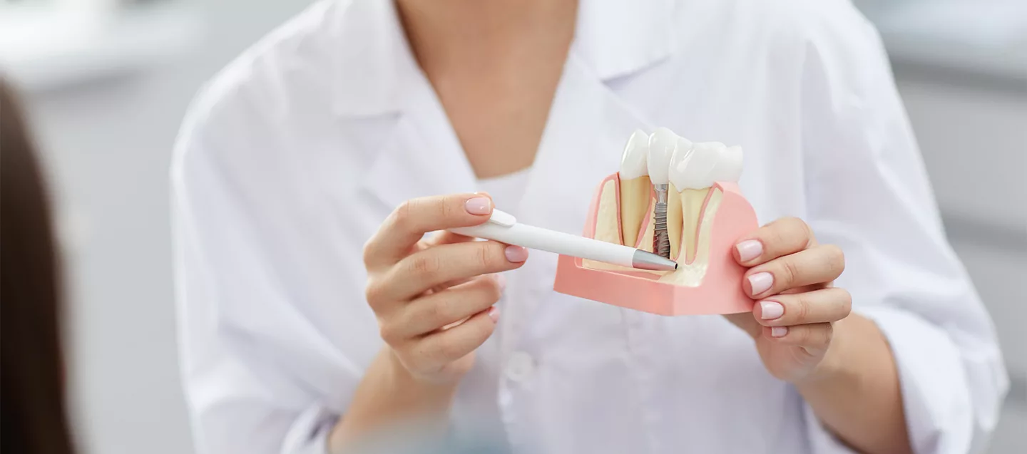 Dental Implants